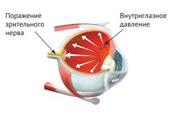 Глаукома