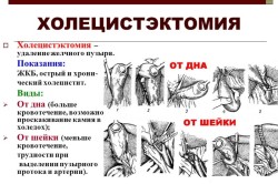 Холецистэктомия