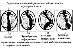 Классификация искривлений по Младину Классификация искривлений по Младину