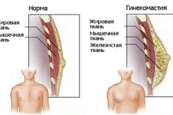 Отличия гинекомастии от нормы