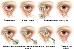 Схема блефаропластики