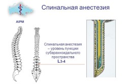 Спинальная анестезия