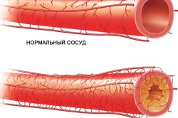 Атеросклероз - показание к шунтированию