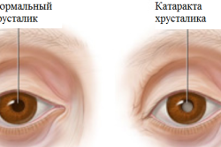 Катаракта хрусталика глаза