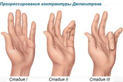 Стадии развития контрактуры Дюпюитрена