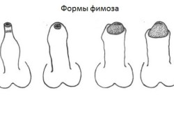 Формы фимоза