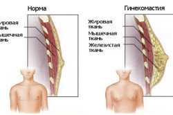 Схема гинекомастии