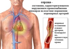 ИБС - показание к операции на сердце