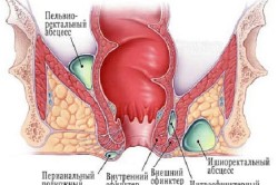 Классификация парапроктита в зависимости от расположения очагов воспаления