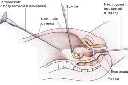 Схема лапароскопии
