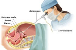 Лапароскопия кисты яичника