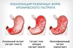 Схема локализации хронических форм гастрита Схема локализации хронических форм гастрита