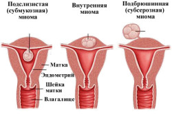 Типы миомы матки