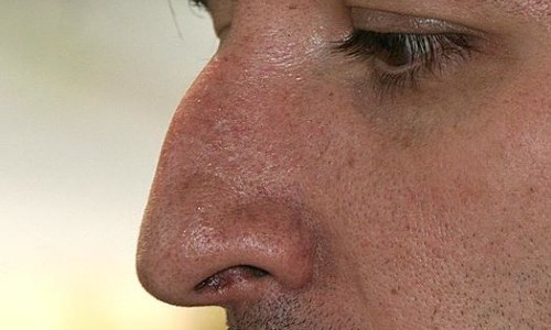Проблема горбинки на носу