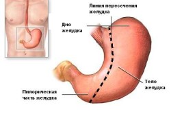 Схема удаления желудка