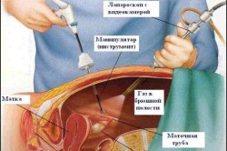Схема лапароскопической операции Схема лапароскопической операции