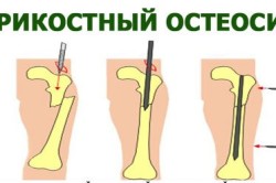 Внутрикостный остеосинтез ключицы