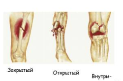 Виды переломов