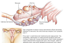 Яичник с кистой
