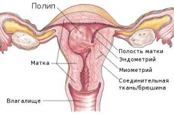 Полип эндометрия
