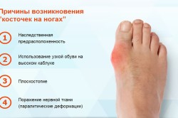 Причины возникновения "косточек" на ногах