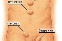 Возможное расположение грыжи в области живота Возможное расположение грыжи в области живота