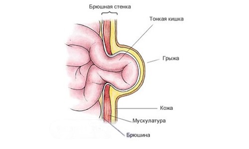 Пупочная грыжа Пупочная грыжа