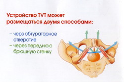 Варианты размещения TVT-устройства