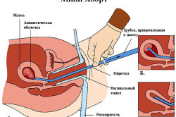 Схема мини-аборта