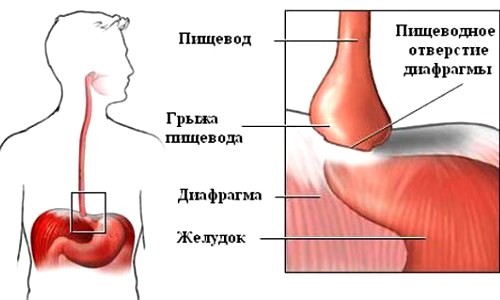 Схема грыжи пищеводного отверстия диафрагмы Схема грыжи пищеводного отверстия диафрагмы