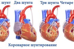Коронарное шунтирование