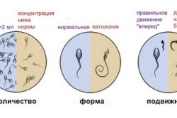 Контроль спермограммы после операции 