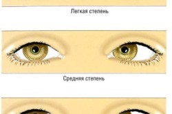 Рисунок 1. Степени косоглазия