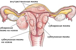 Классификация миом по их расположению относительно матки