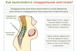 Схема выполнения эпидуральной анестезии