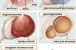 Типы кисты яичника