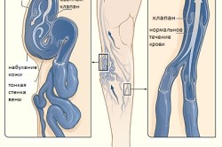 Схема варикозного расширения вен