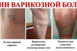 Стадии варикоза