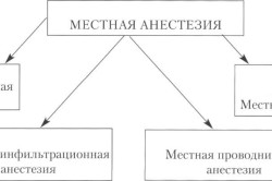 Виды местной анестезии
