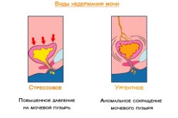 Виды недержания мочи