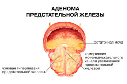 Аденома простаты