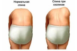 Визуальная диагностика сколиоза 
