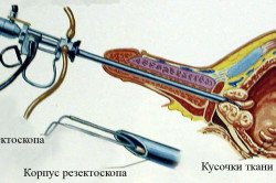 Трансуретральная резекция Трансуретральная резекция