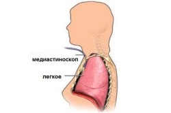 Схема проведения медиастиноскопии